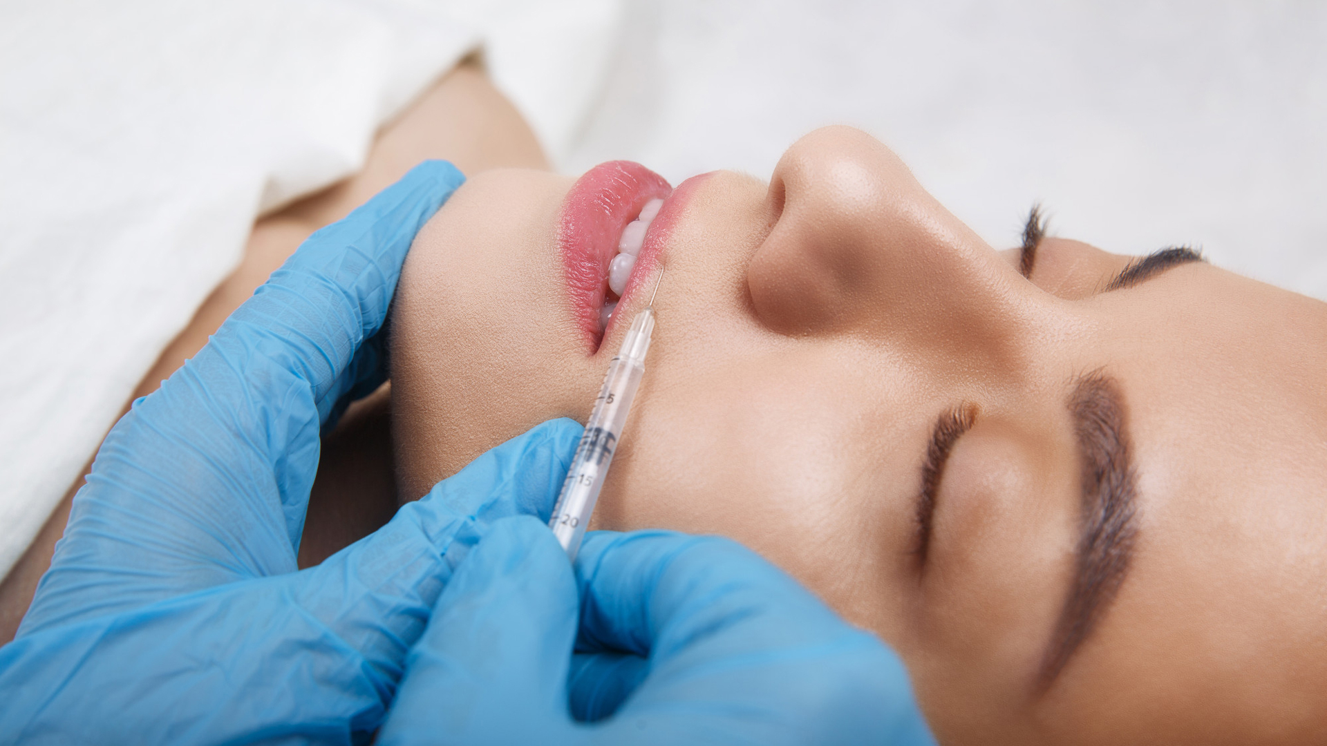 Can You Tan After Lip Fillers?