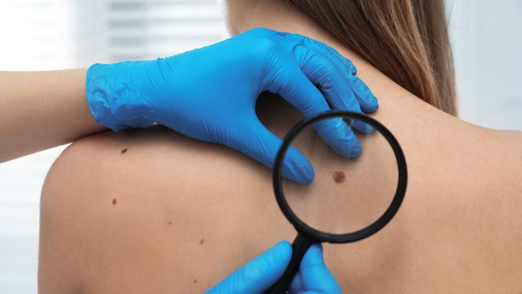 exposure to sun causes melanoma in woman