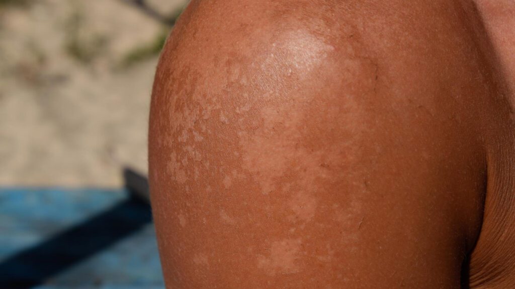 uneven fading of spray tanning