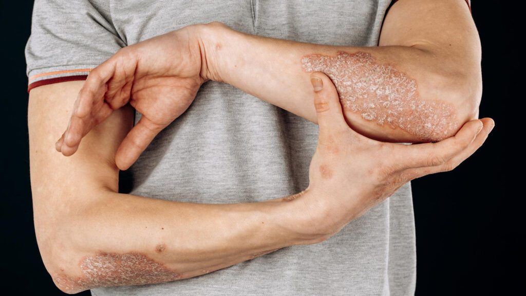 Man suffering from psoriasis
