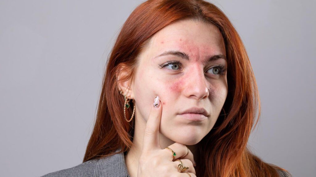 rosacea caused due to excessive tanning