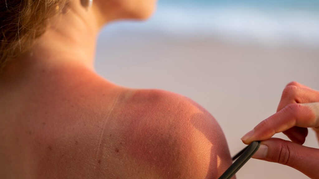 Sunscreen prevent sunburn but no prevent tanning