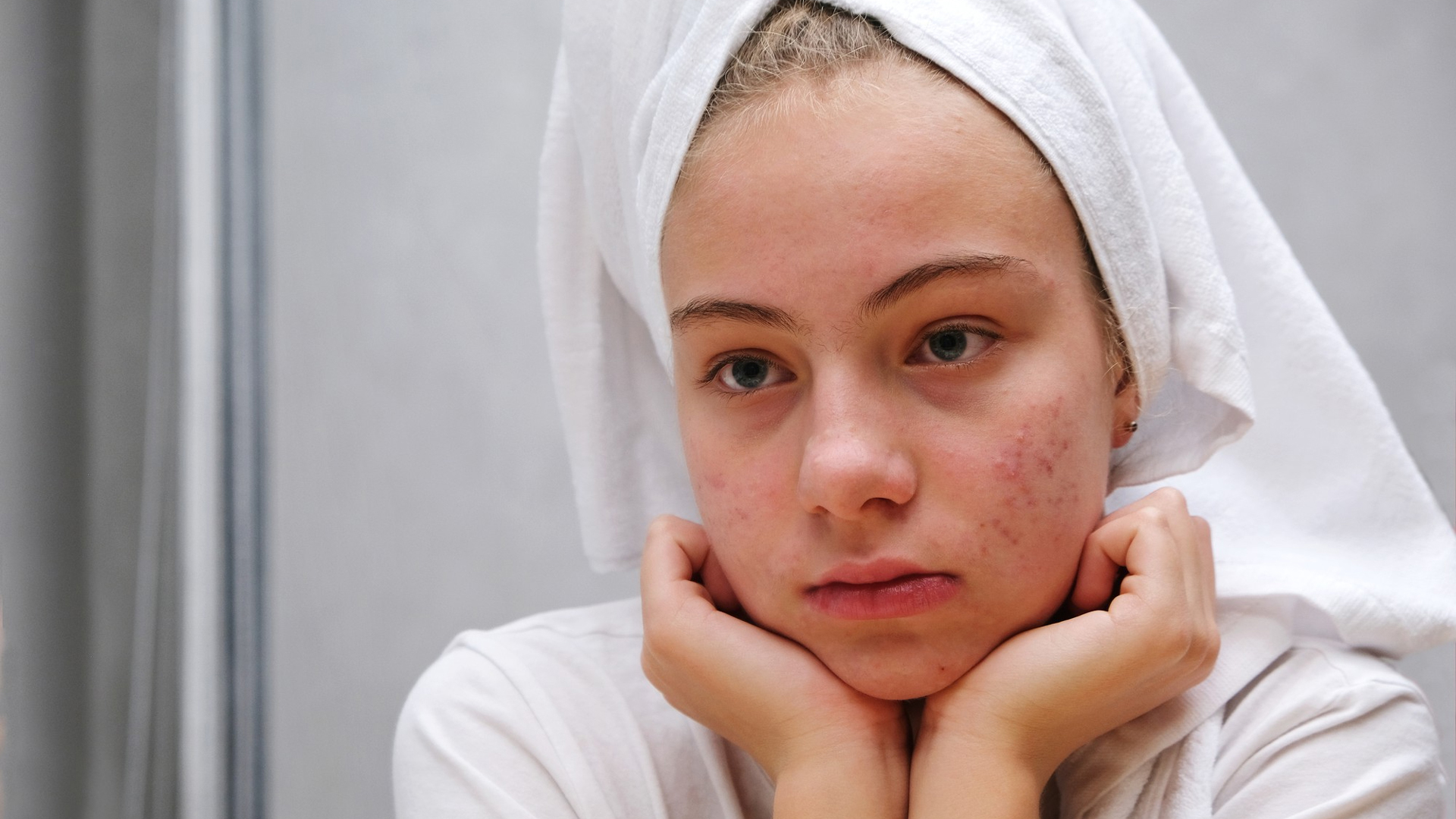 does tanning help acne