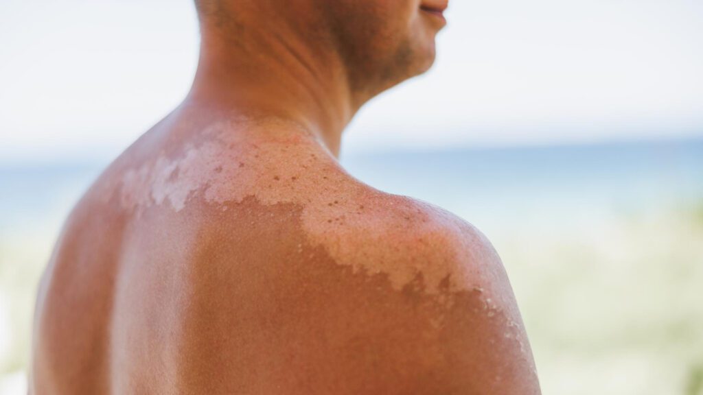 Man having rashes from tanning beds