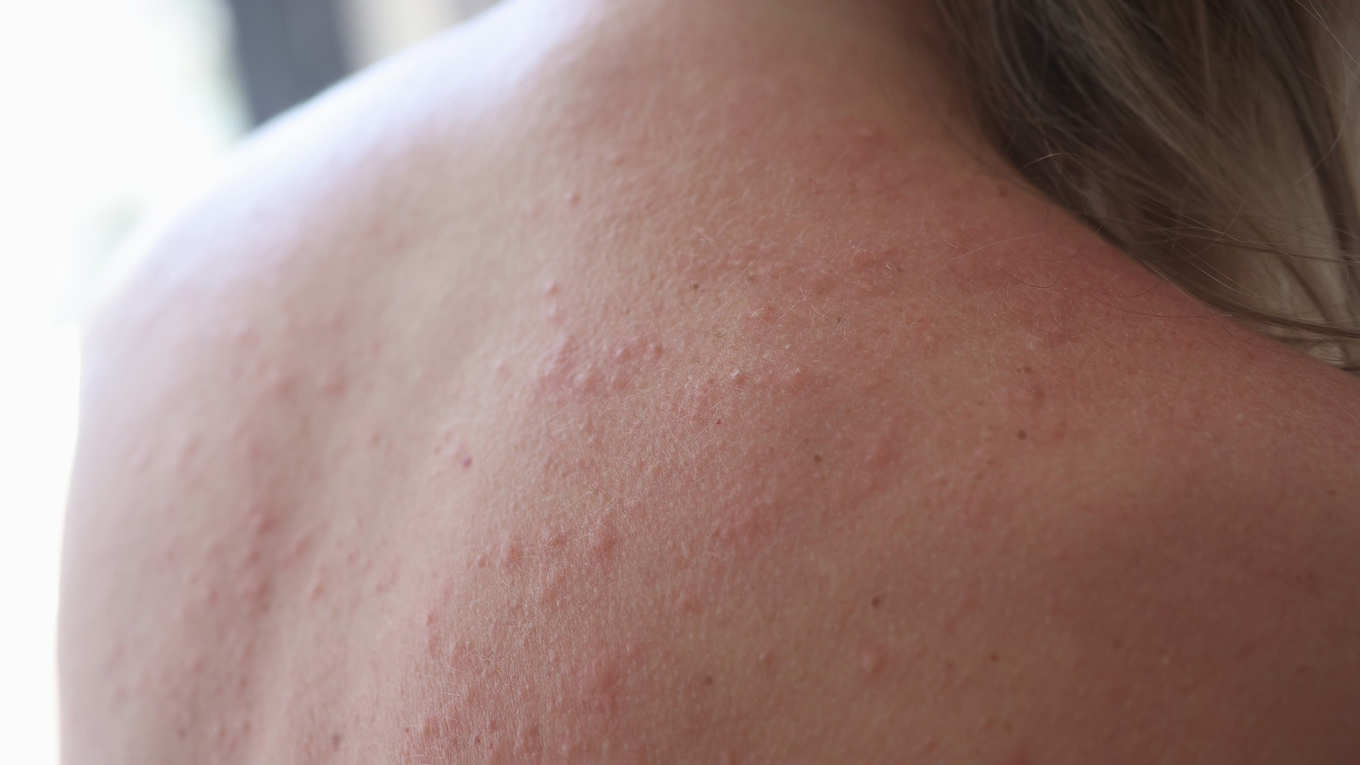 rashes from tanning beds